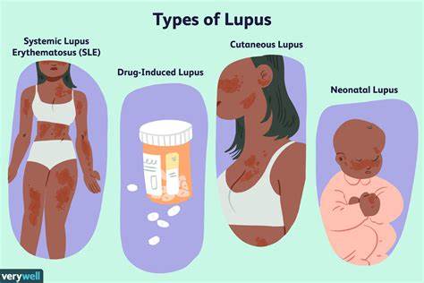 Researchers explore origins of lupus, find reason for condition’s prevalence among women